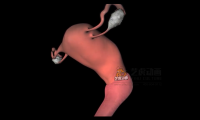 子宫疾病及子宫类疾病治疗三维动画